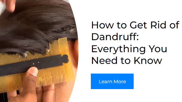 How to Get Rid of Dandruff: Everything You Need to Know